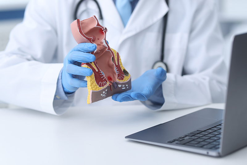 Haemorrhoids specialist explaining to patient using rectum model