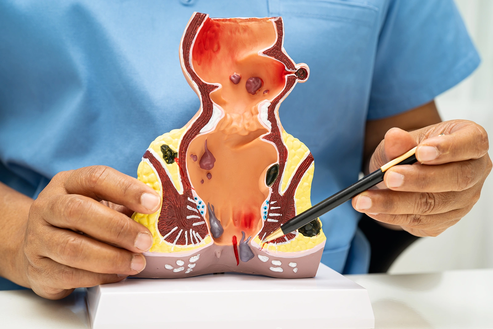 Types of Haemorrhoid Surgery: Which One Is Right for You?